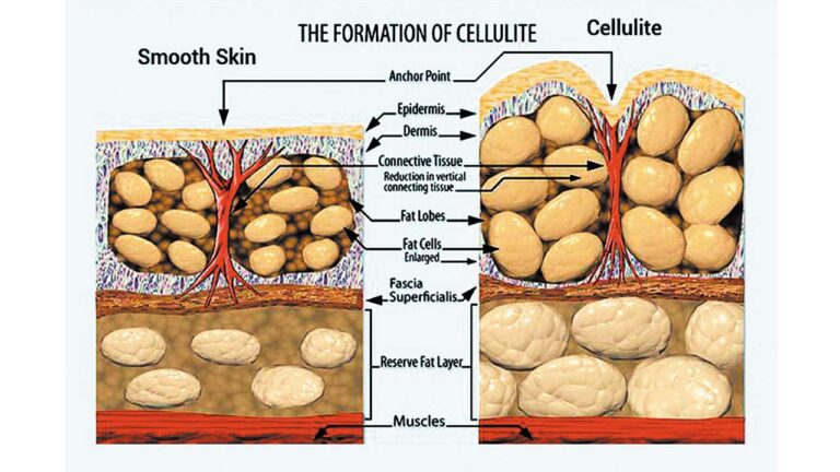 celulit kako nastaje
